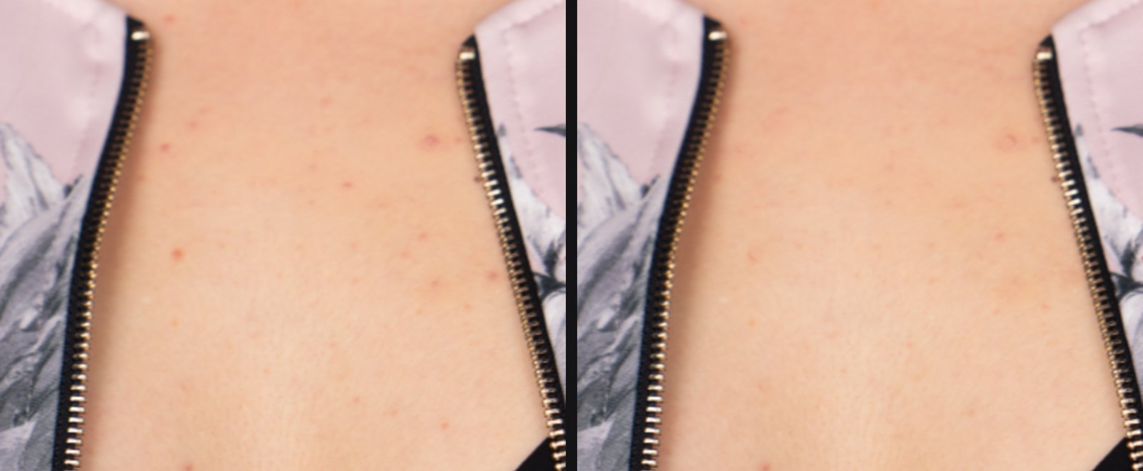 Close-up of a chest: original on the left with many small red spots, on the right after dabbing the skin healing brush in frequency-separation mode, spots gone, skin texture kept